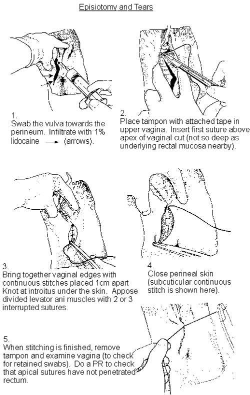 EPISIOTOMY & TEARS