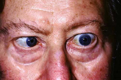 VI AND XII NERVE PALSIES