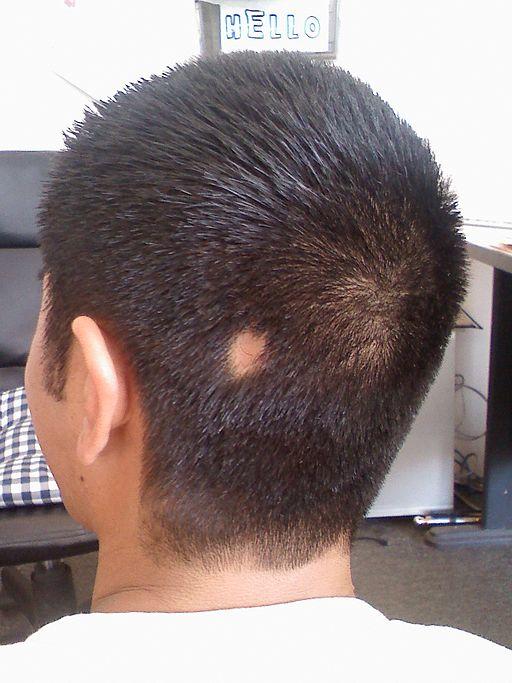 Photo of Alopecia areata bald spot