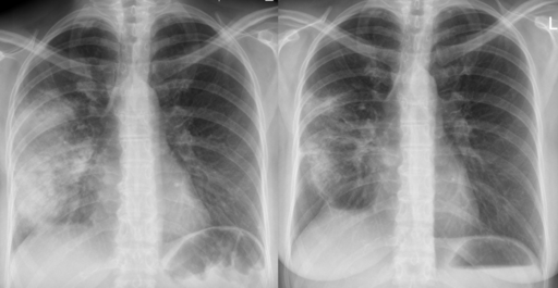 acute pneumonia