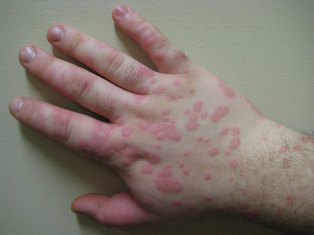 Photo of Erythema multiforme on hand