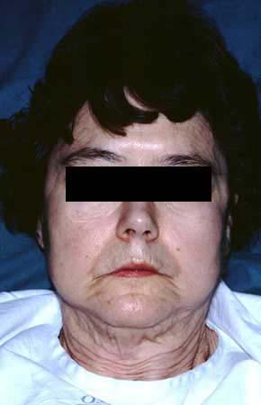 PSEUDOXANTHOMA ELASTICUM