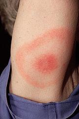 lyme disease erythema migrans
