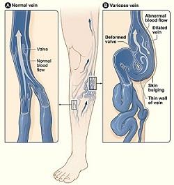 Varicose veins