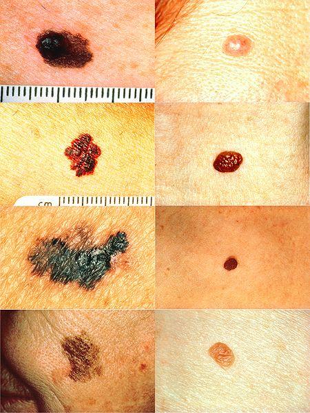 Melanoma vs normal mole ABCD rule