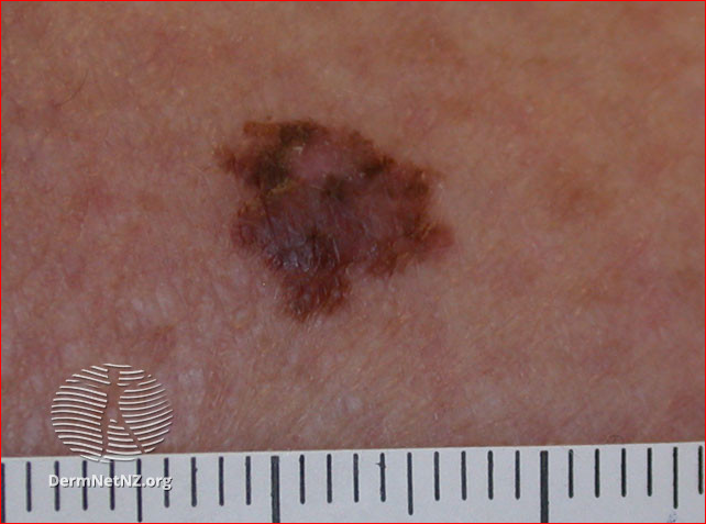 Superficial spreading melanoma