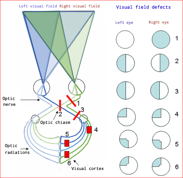 Visual Field Defects