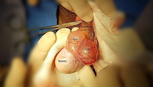 Epididymal cyst