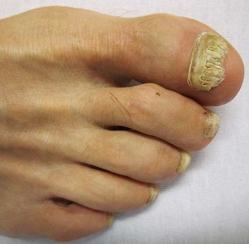 Toe onychomycosis