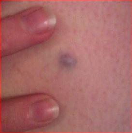 Blue naevus