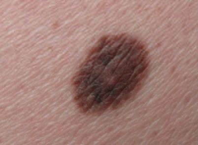 Compound naevus left buttock