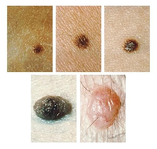 Intradermal naevus