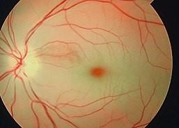 Cherry red spot and retinal swelling of central retinal artery occlusion.