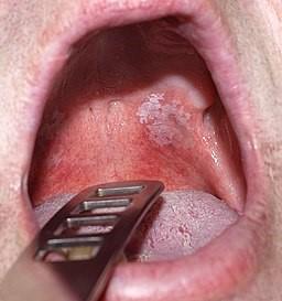 Leukoplakia