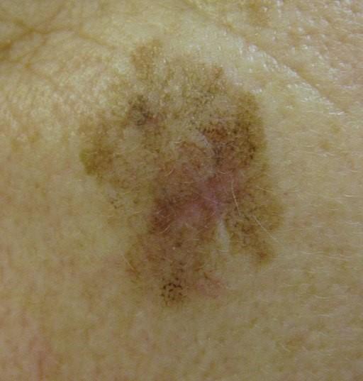 Lentigo maligna