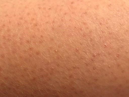 Keratosis pilaris