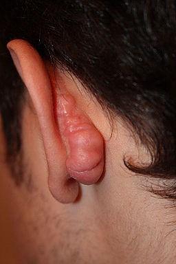 Keloid