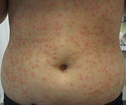 Folliculitis