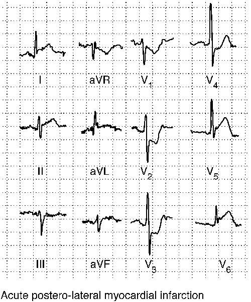 MYOCARDIAL INFARCTION
