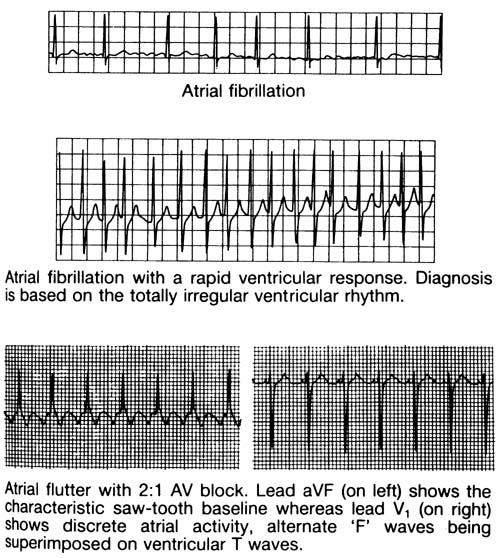 Atrial fibrillation