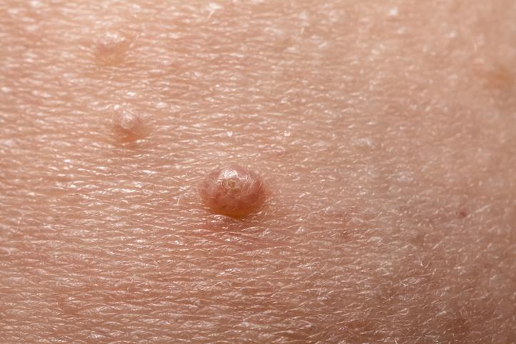 Molluscum contagiosum