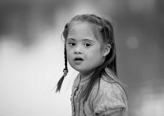 down syndrome