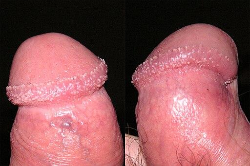 Photo of penile pearly papules
