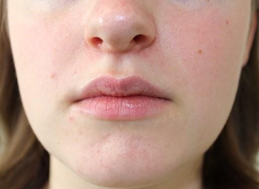 Perioral dermatitis