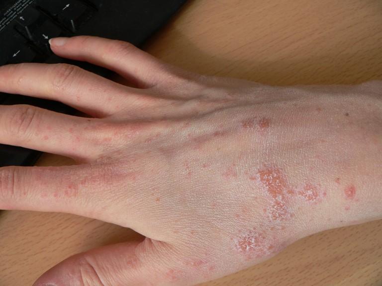 Scabies rash on hand