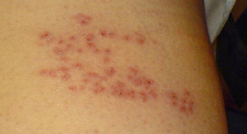 Shingles Day 6 (Wikimedia Commons)