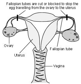 female sterilisation