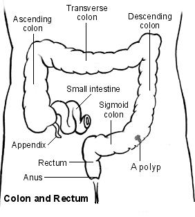 Large bowel showing a polyp