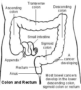 Large bowel showing a cancer