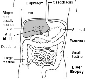 Liver biopsy