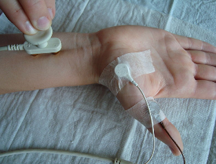 Nerve conduction velocity