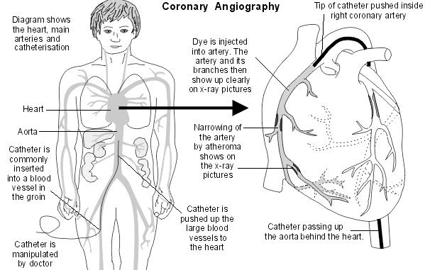 Coronary angiography