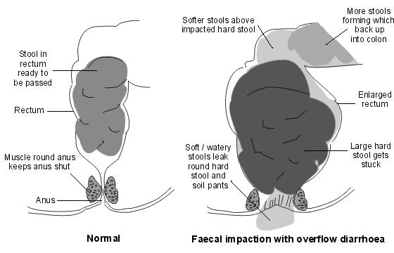 Chronic constipation