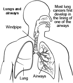 lung cancer
