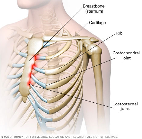 Costochondritis