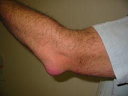 Olecranon Bursitis Elbow