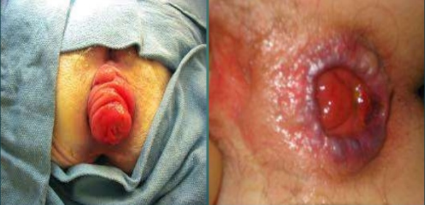 Rectal Prolapse