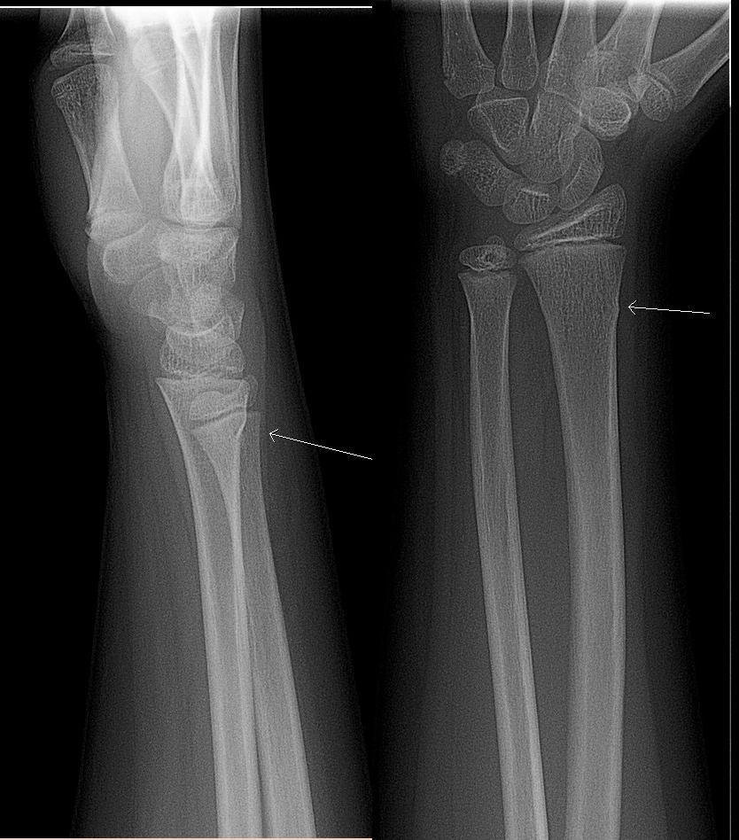 greenstick X-ray