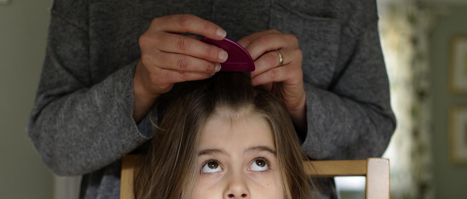 Treating nits and lice