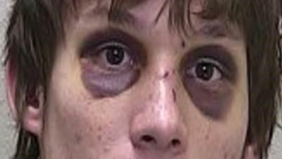 Bilateral periorbital ecchymosis