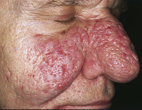 Rhinophyma