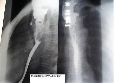 Barium swallow