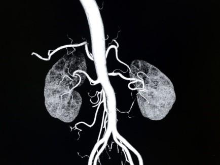 Glomerulonephritis