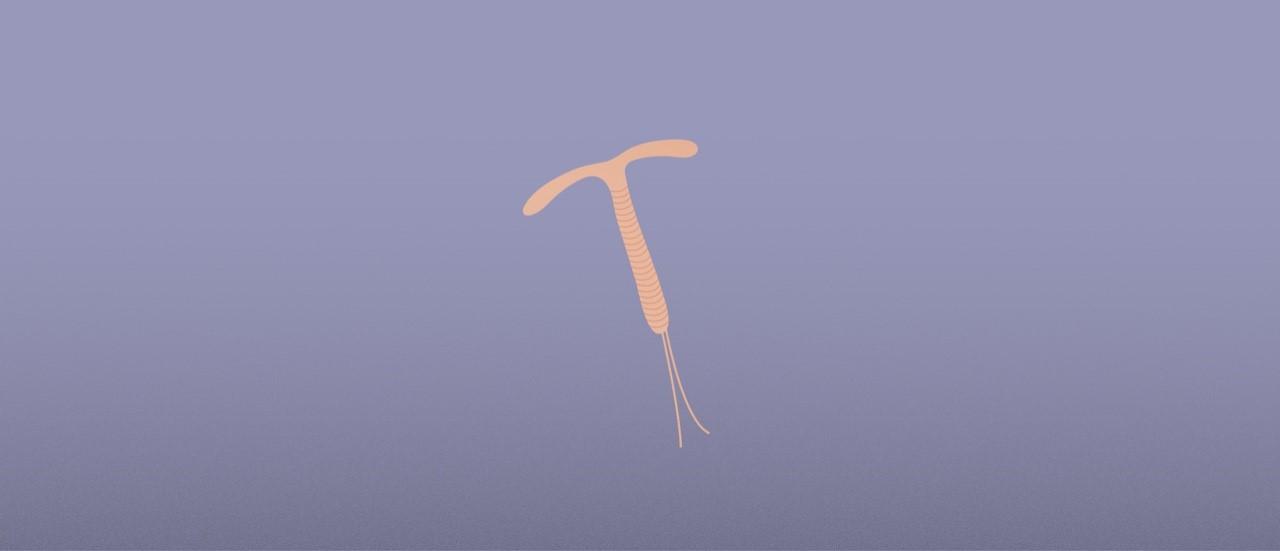 IUD Emergency Contraception