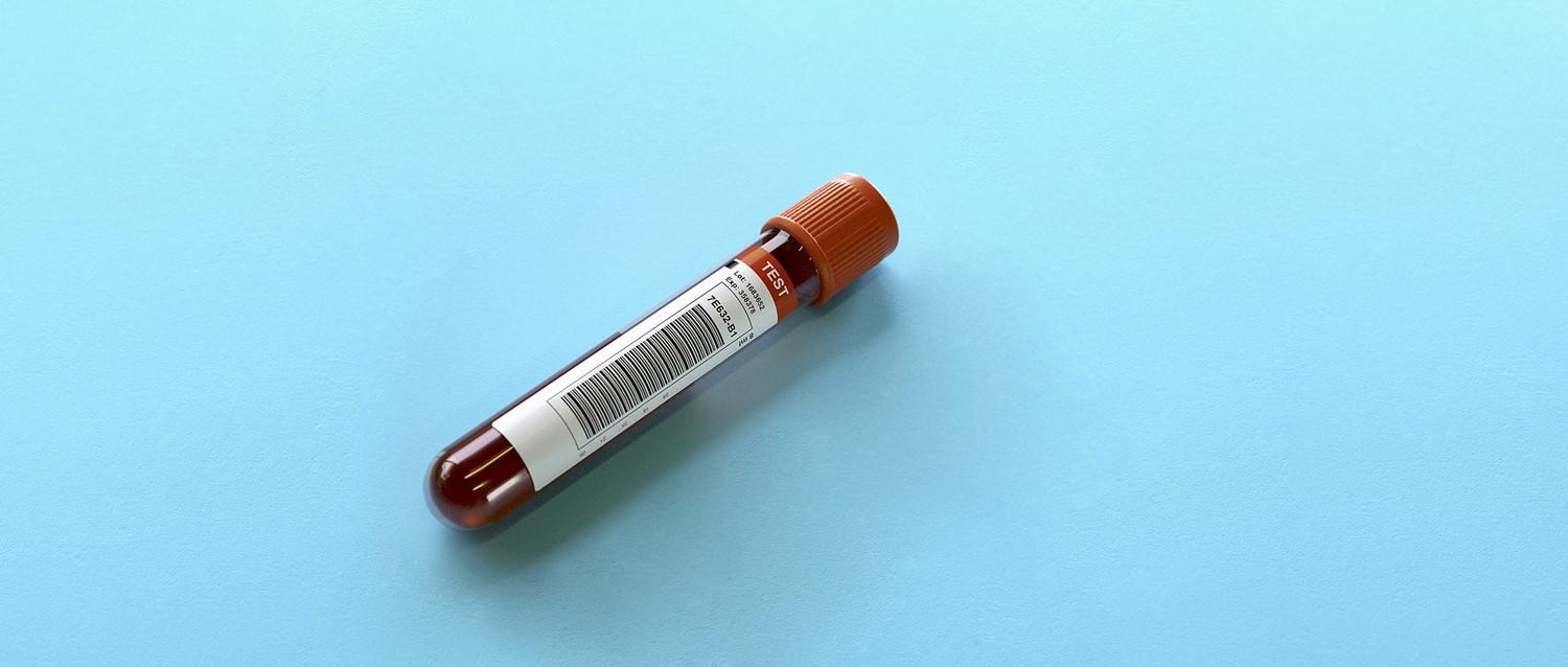 Blood test could predict Alzheimer's 20 years before symptoms