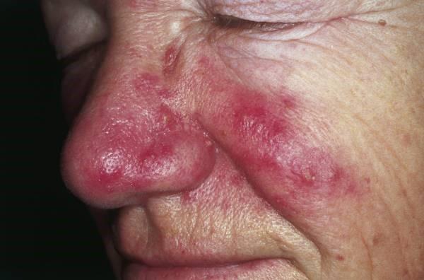 Rosacea on nose and cheeks